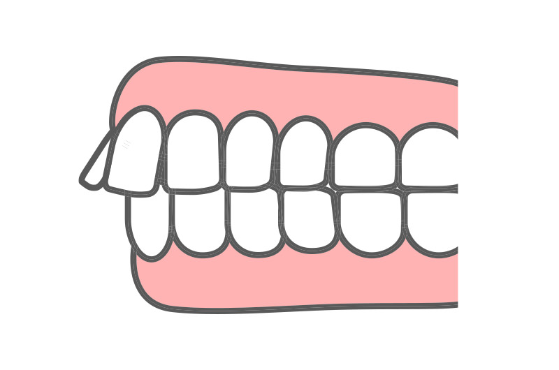 出っ歯（上顎前突）とは？