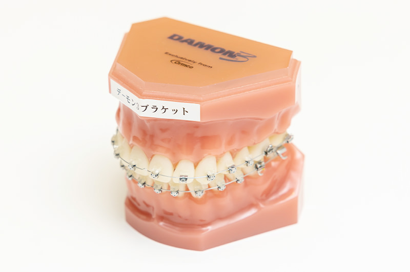 確実な動きを追求する「ワイヤー矯正」